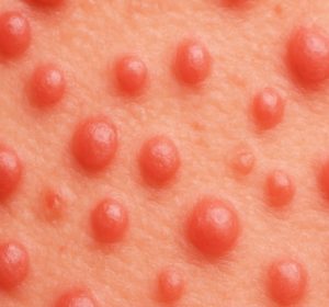 AI generated image of papules on skin closeup