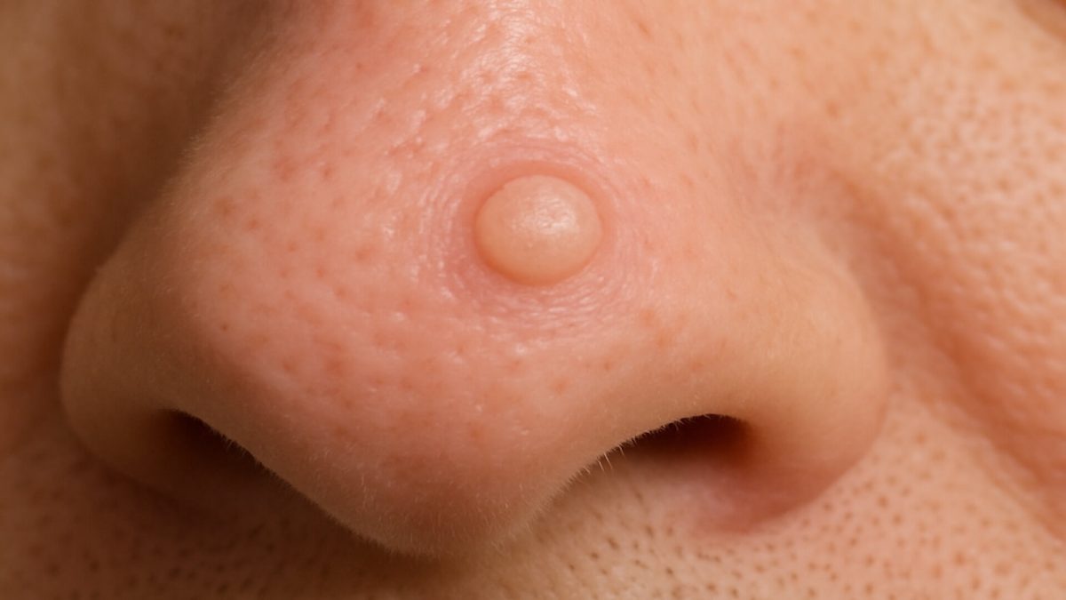 Fibrous papule of the nose closeup