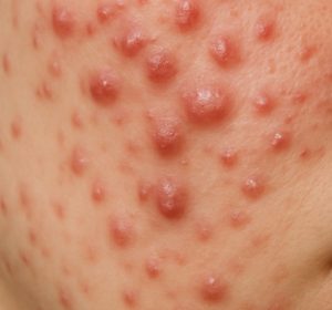 Severe cystic acne on cheek closeup