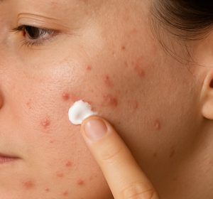 Woman applying acne treatment to face