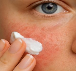 Woman applying prescription face cream for rosacea