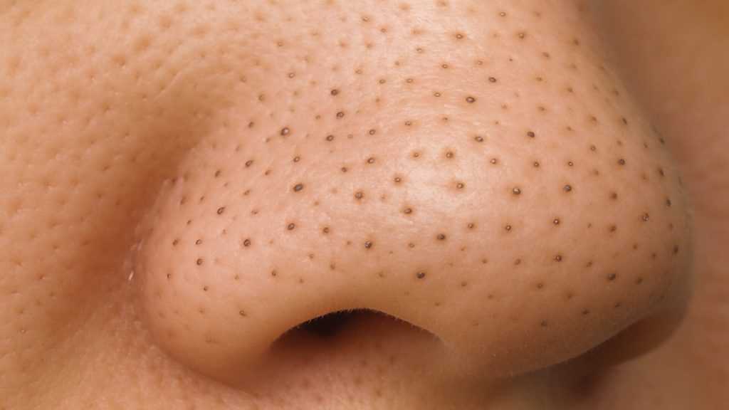 Closeup of blackheads on nose
