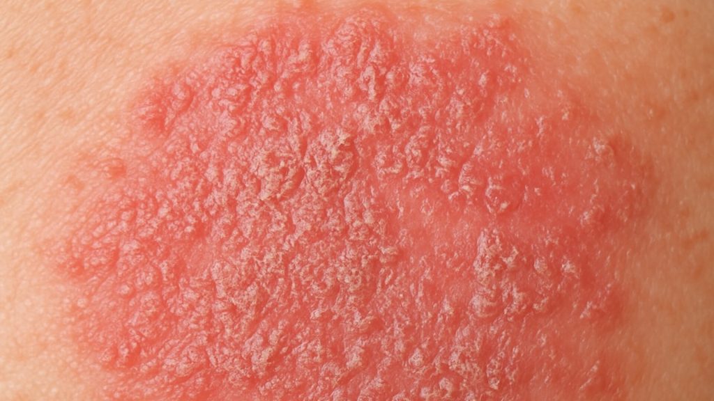 Closeup image of contact dermatitis