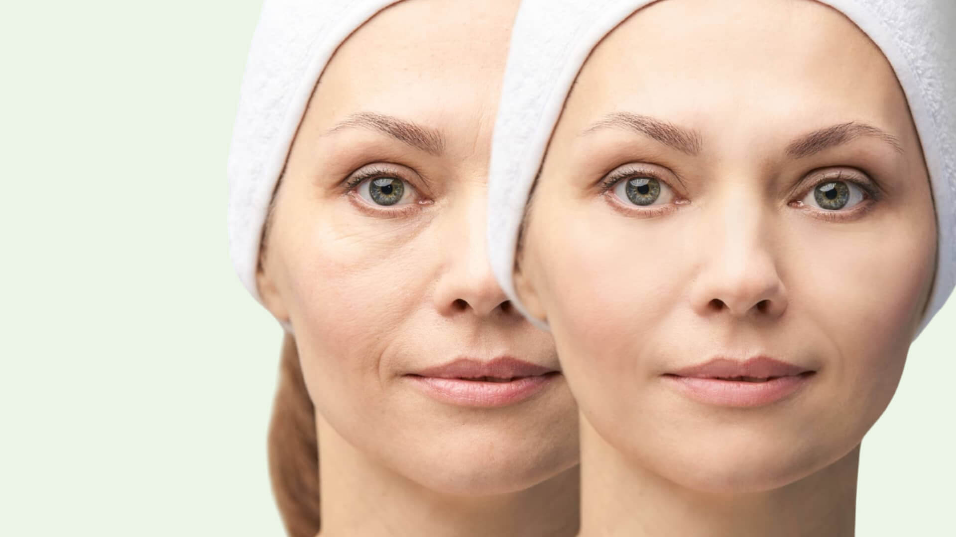 Fine Lines | Volume | Firmness