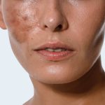 Hyperpigmentation