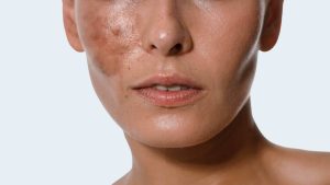 Dark Spots • Sun Damage • Melasma