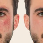 Rosacea