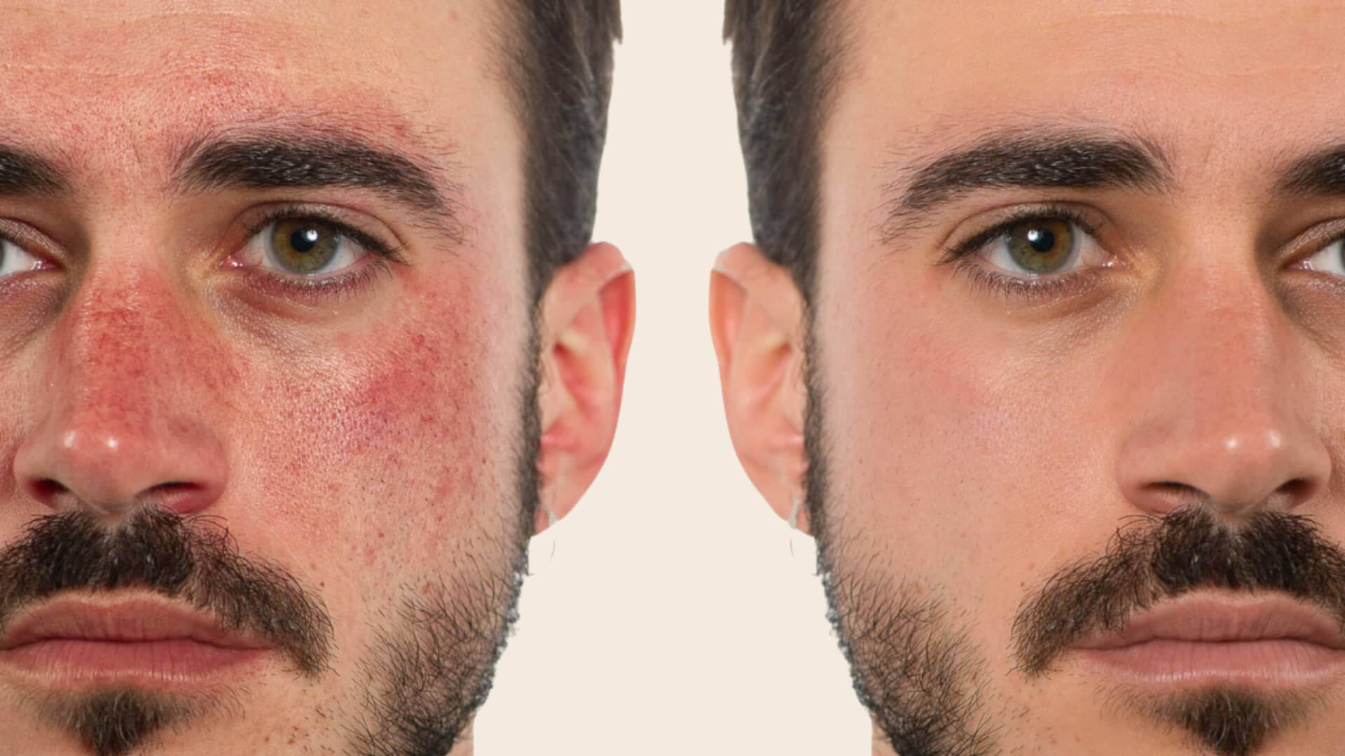 Redness | Burning | Sensitivity