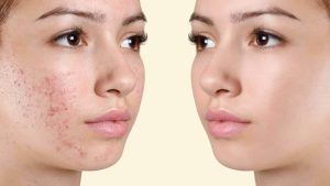 Hormonal • Congestion • Blackheads