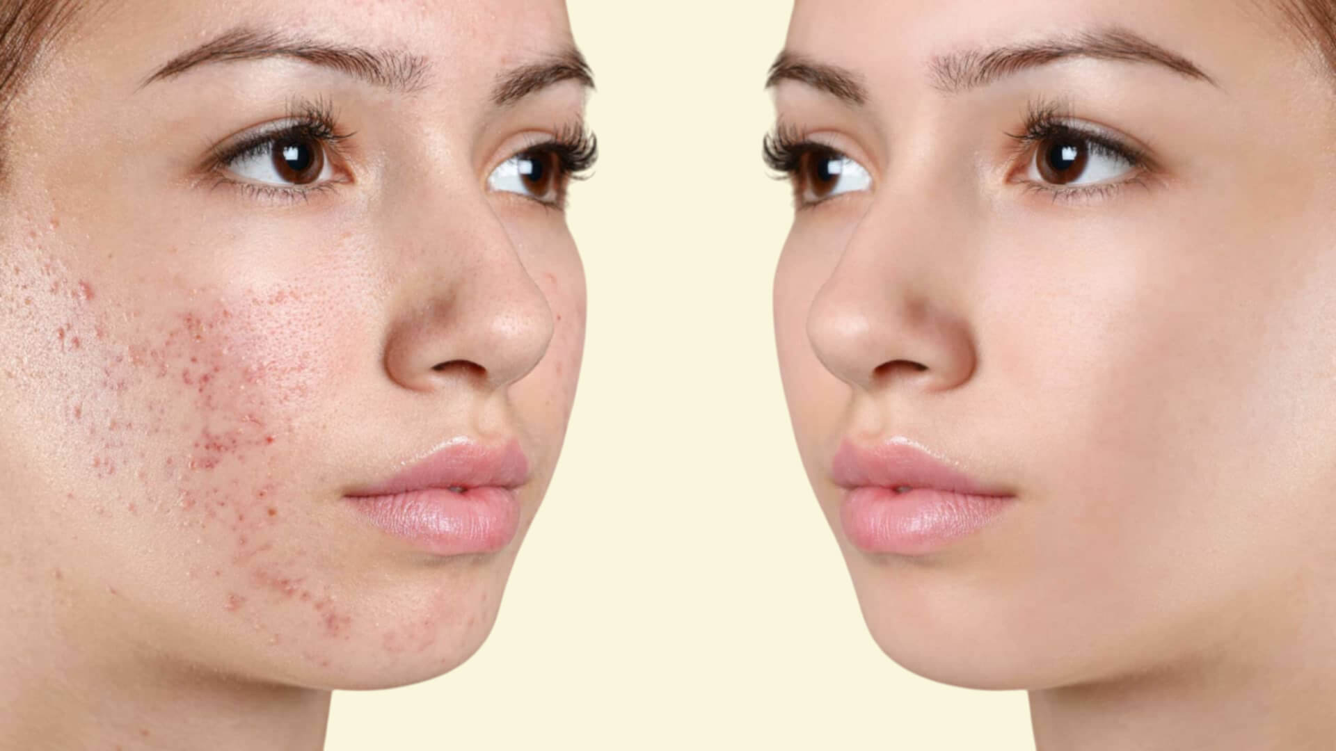 Blackheads | Pimples | Pitting