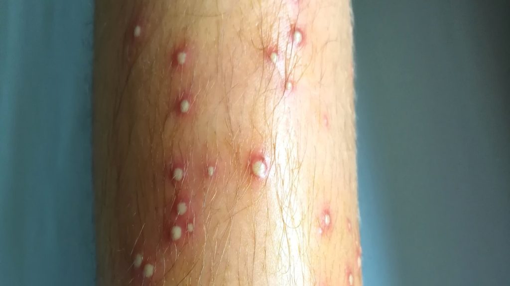 Pustular folliculitis of lower leg