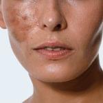 Hyperpigmentation